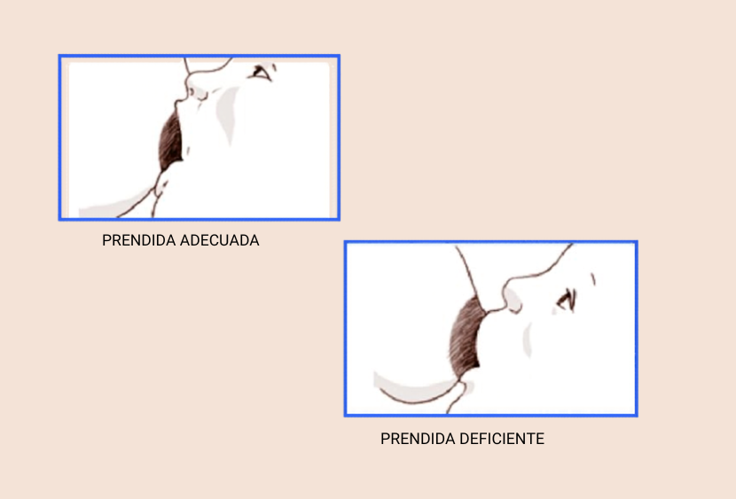"Comparación esquemática de lactancia materna: arriba, prendida adecuada asimétrica con mentón pegado; abajo, prendida deficiente superficial con nariz bloqueada".